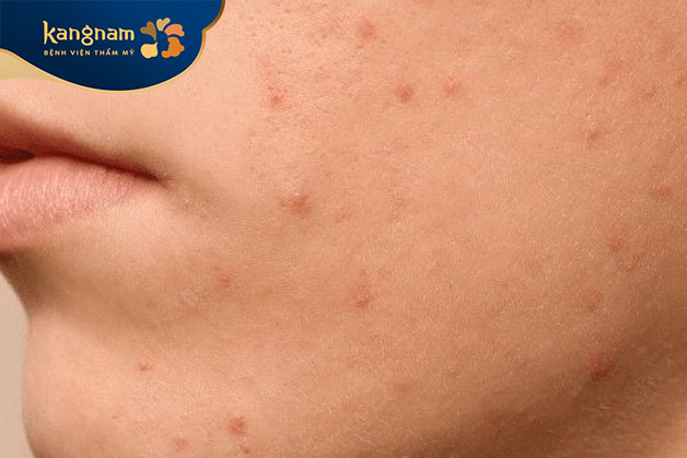 Đẩy mụn do cơ chế tự nhiên của AHA