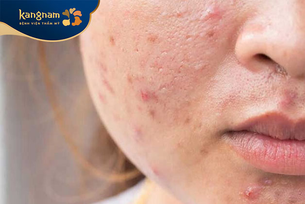 Đẩy mụn do dị ứng AHA