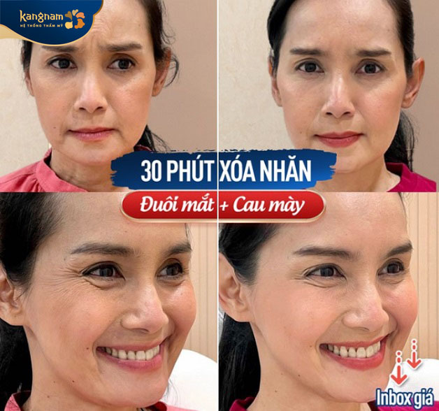 Khách hàng tiêm botox xóa nhăn, gương mặt mịn màng, tươi trẻ, xóa mờ các nếp nhăn.