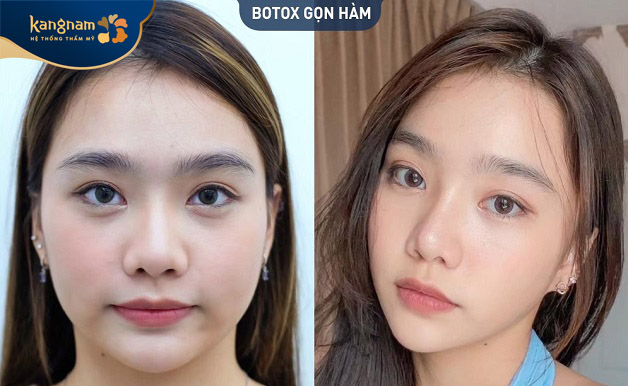 Phương pháp tiêm botox thon gọn hàm an toàn, hiệu quả rõ rệt. Gương mặt trở nên gọn gàng, chuẩn V line.