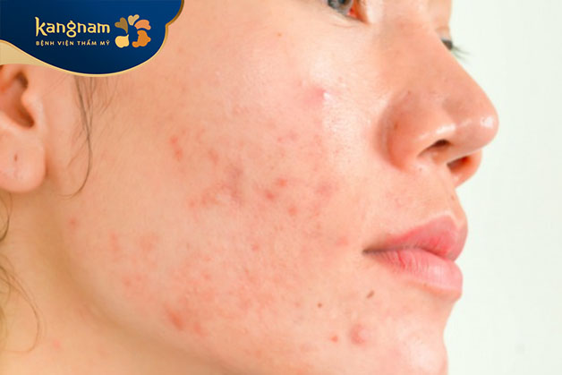 BHA và Niacinamide có khả năng điều trị mụn