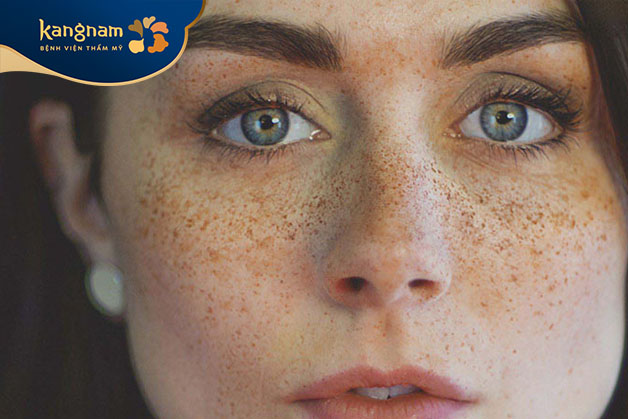 Nám khiến gương mặt bị xỉn và tối màu