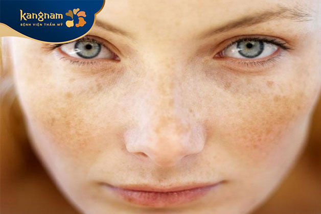 Đốm nâu từ mũi lang sang hai bên gò má