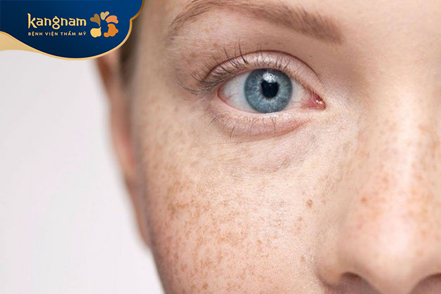 Đốm nám li ti khiến nhiều phụ nữ tự ti