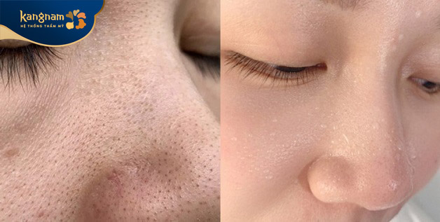 Khách hàng đánh giá cao kết quả sau hút mụn