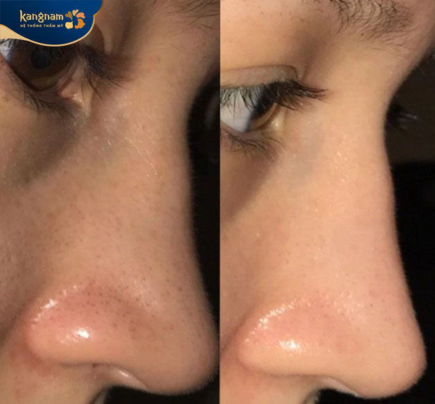 Khách hàng chỉ tin tưởng tìm đến cơ sở hút mụn đầu đen lớn, uy tín trên thị trường để hút mụn