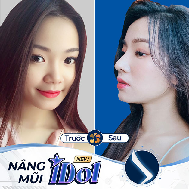 Dáng mũi Idol mềm mai, nhẹ nhàng, ít sưng tấy
