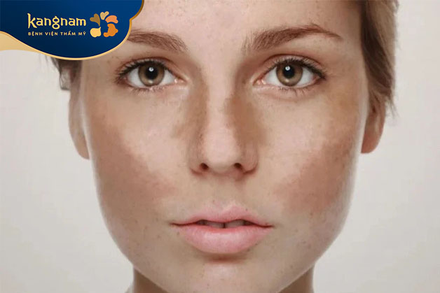 Nám hình cánh bướm là các đốm tròn nhỏ có màu nâu