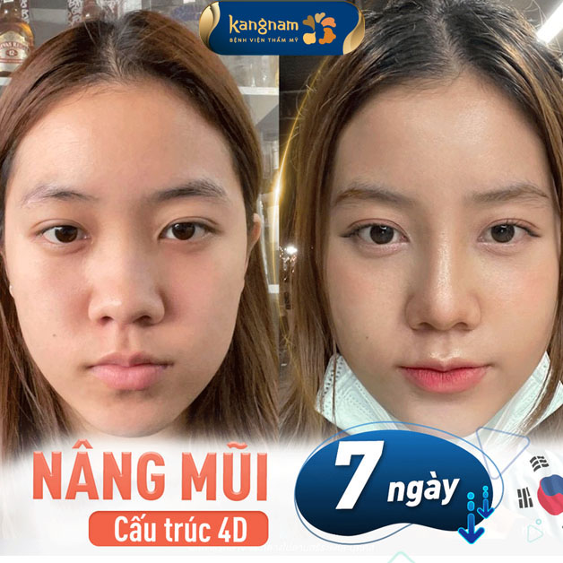 Nâng mũi cấu trúc tự nhiên, bền đẹp