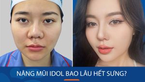 Nâng mũi Idol bao lâu hết sưng? Bí quyết giảm sưng nhanh chóng