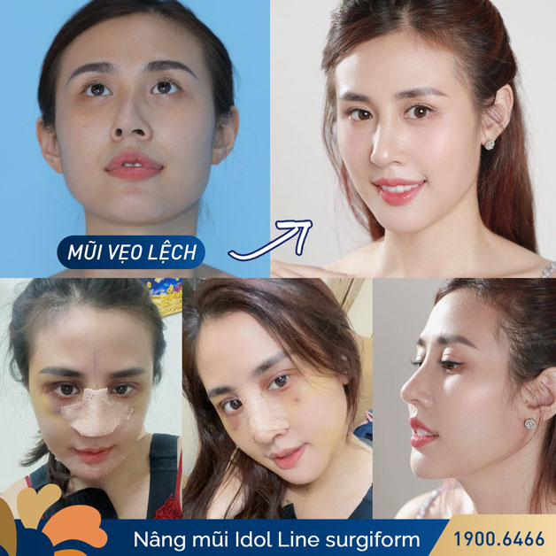 Chỉnh sửa mũi vẹo lệch toàn diện cho khách hàng