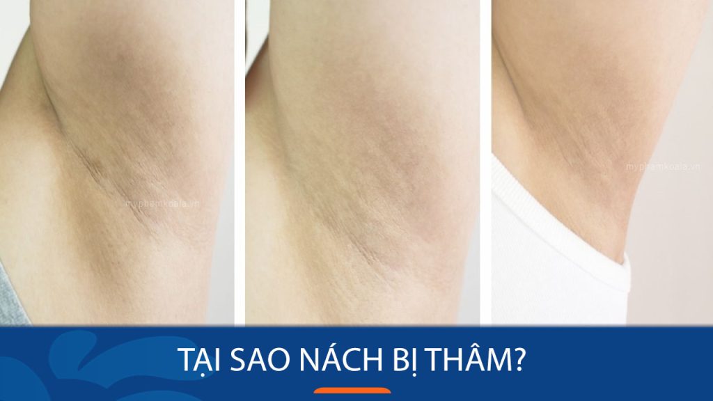 Tại sao nách bị thâm? Các dấu hiệu nhận biết thâm nách