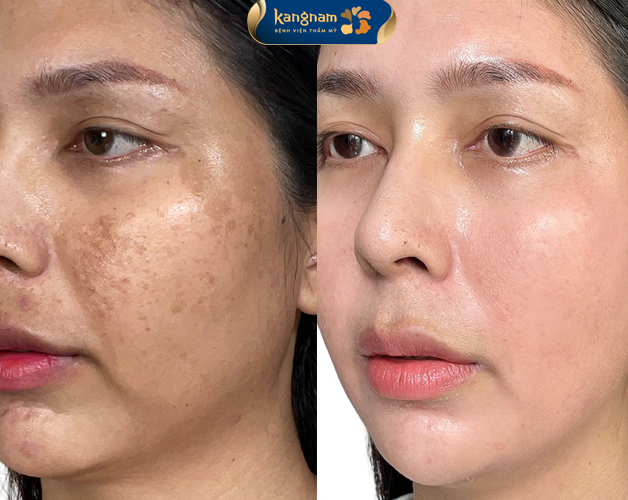 Loại bỏ nám và giúp da sáng khỏe hơn