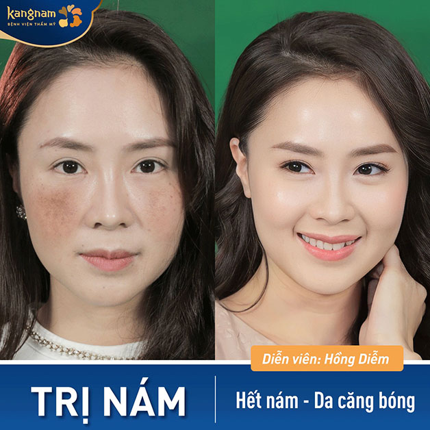 Diễn viên Hồng Diễm rạng rỡ sau khi trị nám thành công