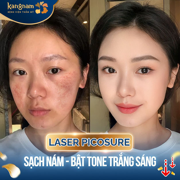 Điều trị nám hình cánh bướm hiệu quả sau 1 liệu trình