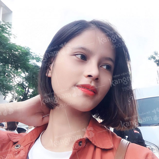 Nâng mũi thường chỉ nâng cao sống mũi, thời gian thực hiện nhanh, ít xâm lấn