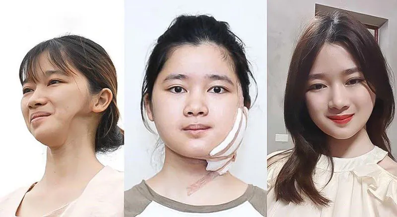 Ninh Thu Hường thay đổi ngoạn mục sau chỉnh hàm, độn thái dương