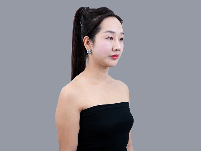 Xác định ngực lép bằng kích thước số đo