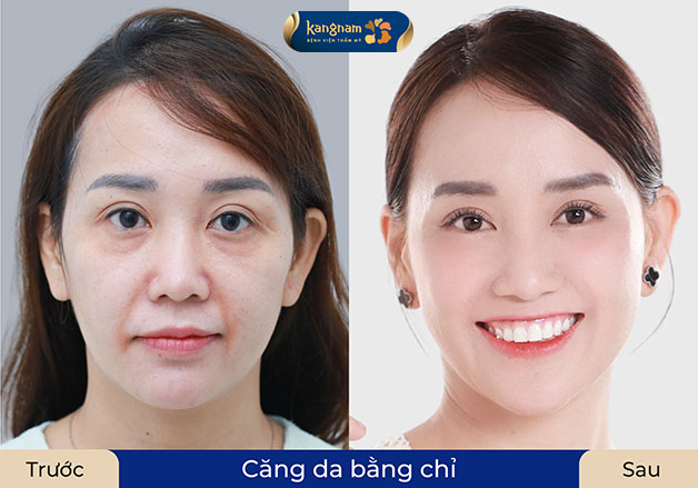 Trẻ hóa da tự nhiên, hạn chế xâm lấn