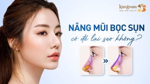 Nâng mũi bọc sụn có để lại sẹo không? Vị trí sẹo và cách hạn chế