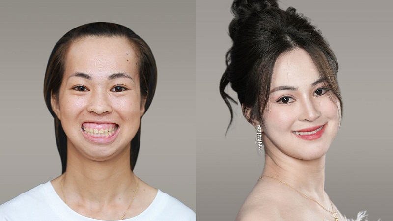 Kim Phượng lột xác ngoạn mục sau chỉnh hàm tại Kangnam