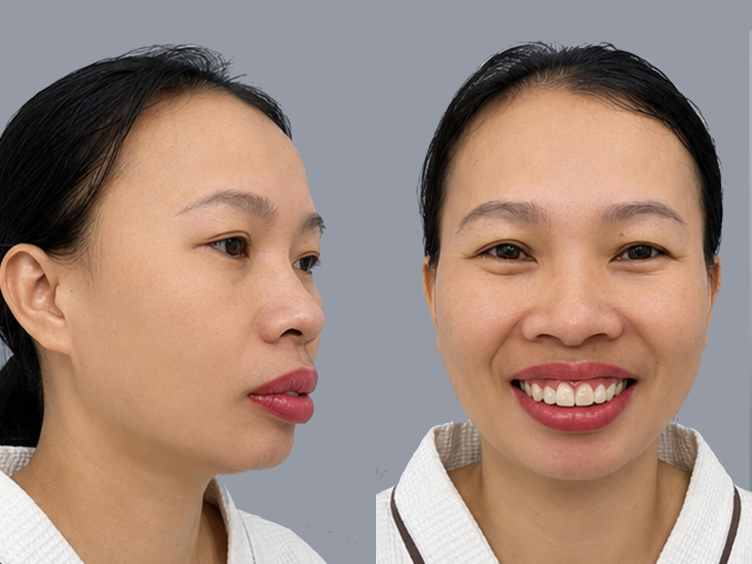 Chị Thanh gặp tình trạng hàm hô chìa ra trước, cằm ngắn
