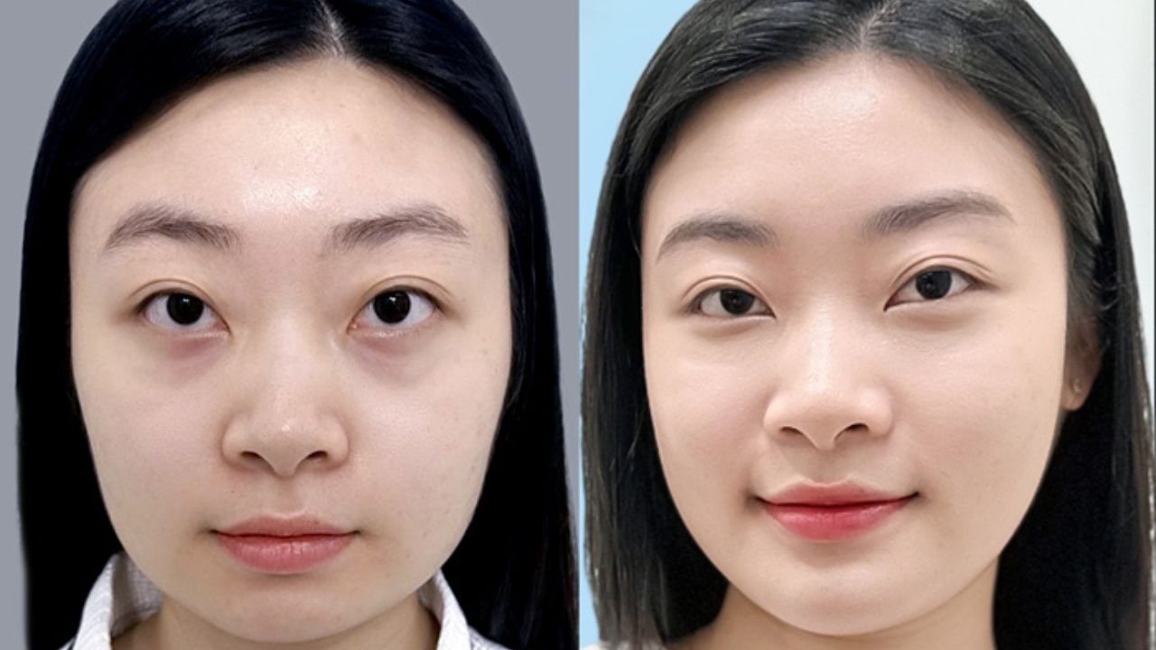 Khách hàng Yến Nhi cải thiện được hàm to bạnh sau gọt hàm