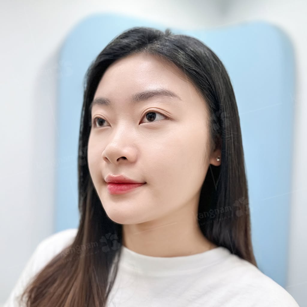 Sau gọt hàm kết hợp trượt cằm gương mặt đã thon gọn, cân đối hơn