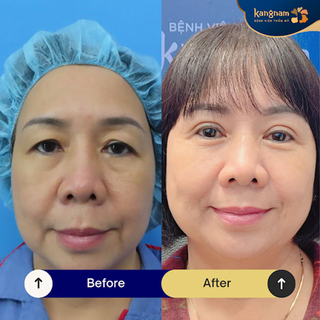 Người trung niên mắt sụp mí, nhiều da chùng nên cân nhắc cắt mí