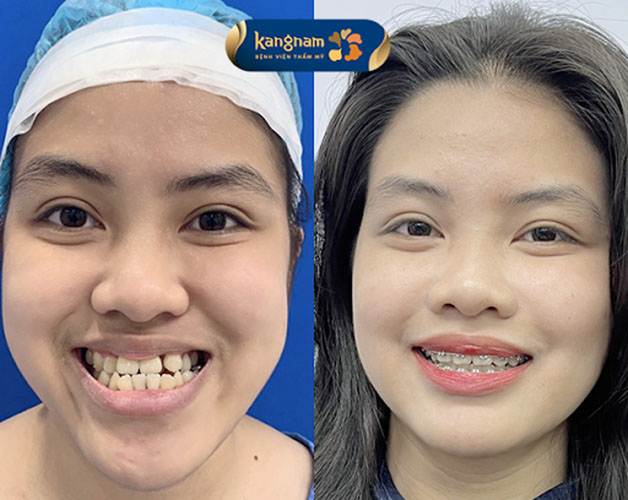 Cải thiện hàm lệch bằng cách chỉnh hình hàm kết hợp niềng răng