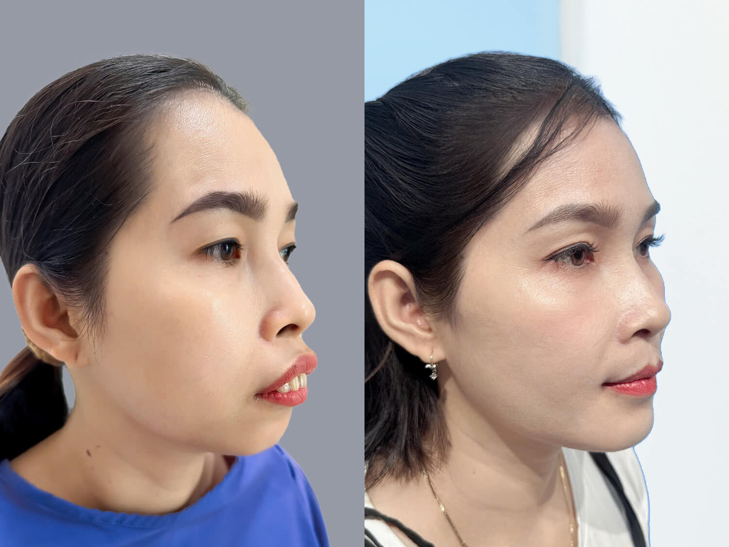 Chị Loan đã có gương mặt và khớp cắn chuẩn sau chỉnh hàm hô