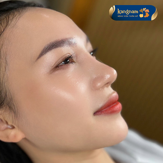 Sụn Surgiform mềm mại, dễ điều chỉnh nên có thể tạo dáng mũi linh hoạt