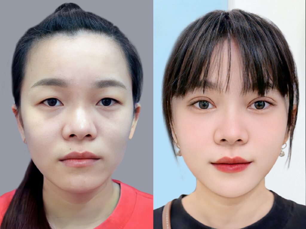 Cắt mí đúng thời điểm giúp đạt hiệu quả tốt