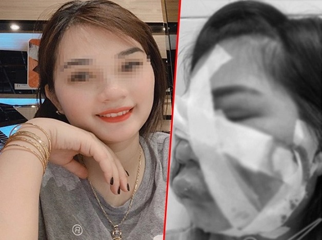 Biến chứng cấy mỡ mặt nghiêm trọng