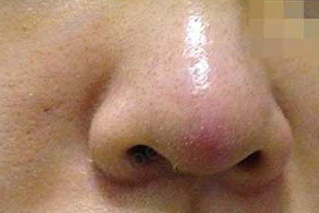 Những biến chứng có thể gặp khi nâng mũi không đảm bảo chất lượng