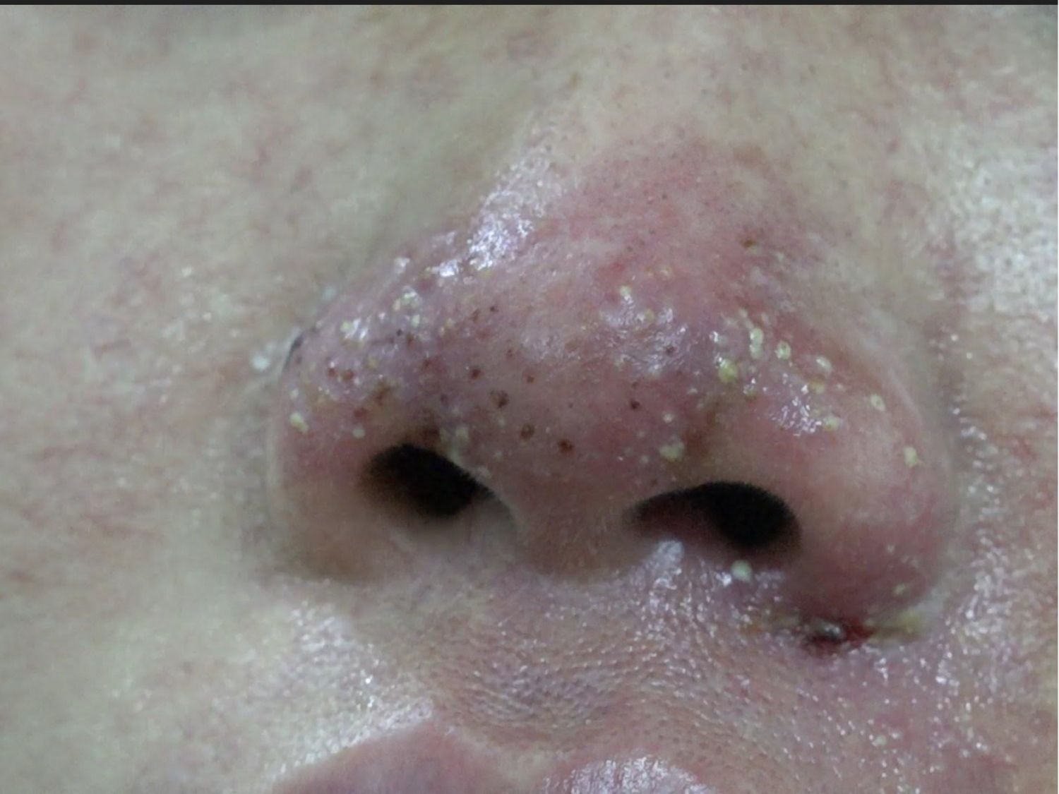 Sưng bầm do biến chứng