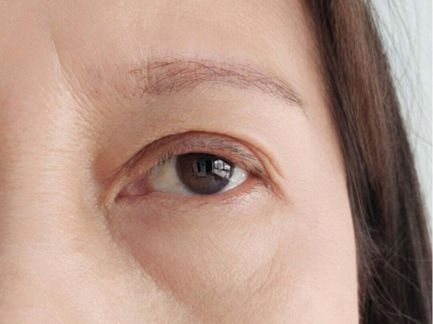 Mí mắt không giữ được vị trí ban đầu