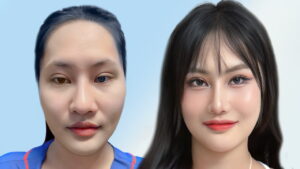 Cách hạ gò má cao: Mẹo giúp mặt thon gọn hơn tại nhà và khi nào cần can thiệp