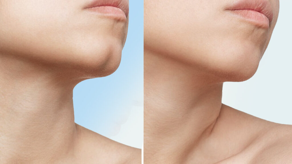 Cằm chẻ là gì? Ý nghĩa thẩm mỹ, yếu tố di truyền và cách tạo cằm chẻ