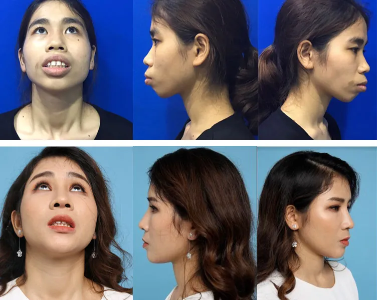 Cao Thị Lan lột xác ngoạn mục sau chỉnh hàm hô kết hợp trượt cằm