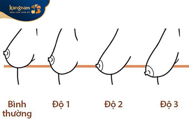 Các cấp độ chảy xệ sau sinh