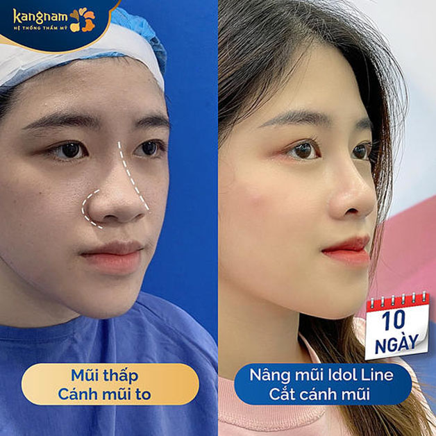 Cắt cánh mũi kết hợp nâng mũi giúp bạn khách sở hữu mũi đẹp tỷ lệ vàng