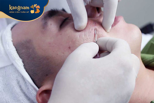 Cắt đáy sẹo gây đau rát và khó chịu