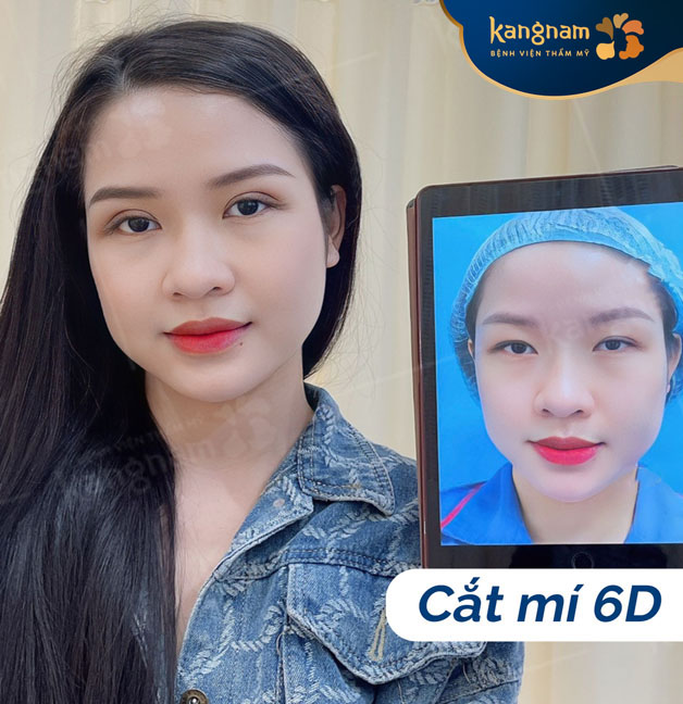 Phẫu thuật cắt mí 6D tại Kangnam khắc phục tình trạng sụp mí hiệu quả