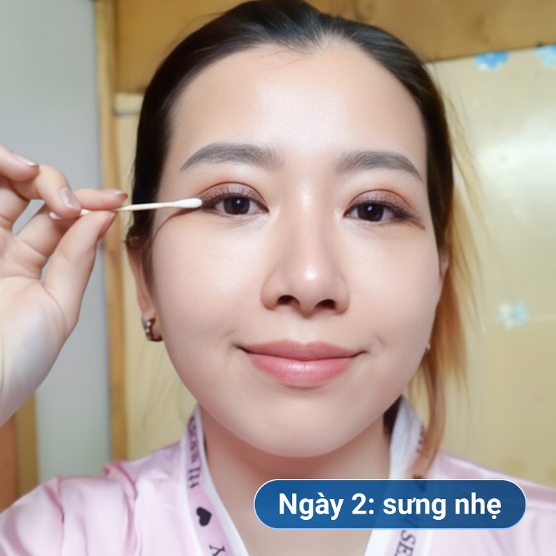 Tình trạng mắt sưng bầm nhẹ sau cắt mí ngày thứ 2 là phản ứng sinh lý bình thường của cơ thể.