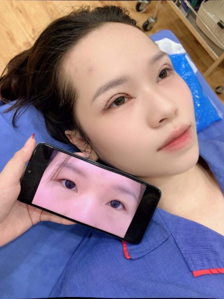 Cắt mí không đúng cách có thể gây tổn thương cho mắt