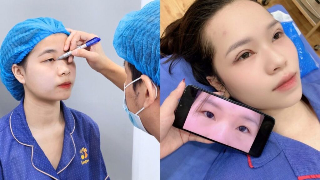 Cắt mí mắt có nguy hiểm không? Giải đáp mọi thắc mắc!