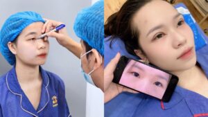 Cắt mí mắt có nguy hiểm không? Giải đáp mọi thắc mắc!