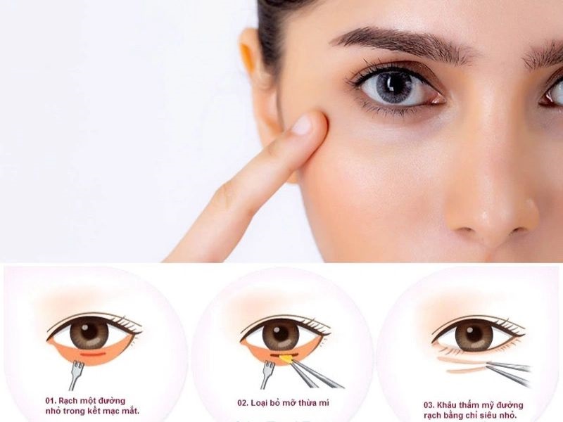 Cắt mí mắt dưới đúng cách sẽ không để lại sẹo