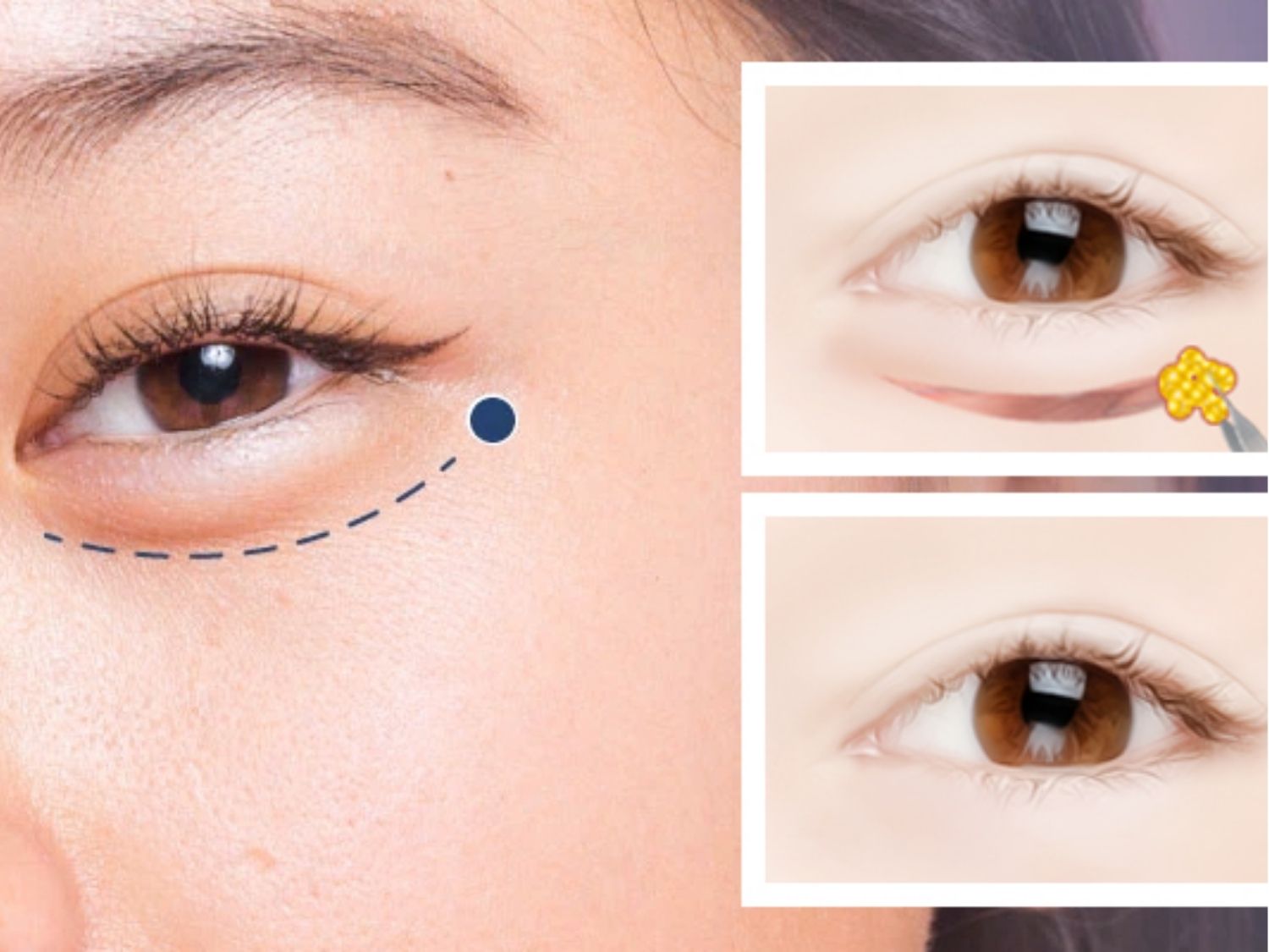 Cắt mí dưới là một phương pháp thẩm mỹ lấy mỡ bọng mắt